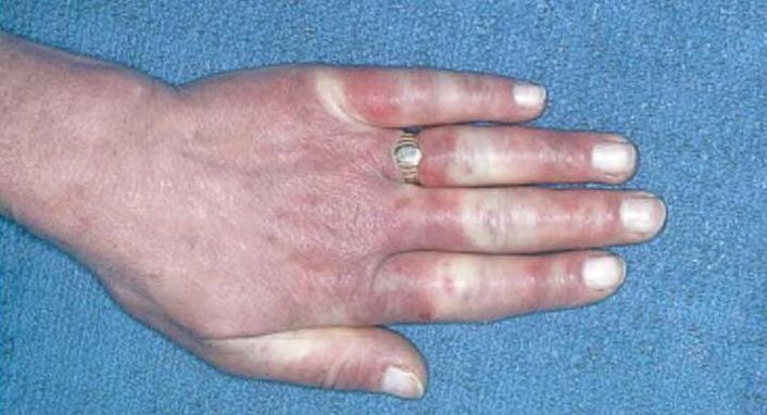 Raynaudi sündroomi kliiniline pilt - vasospasm, hüperemia, tursed