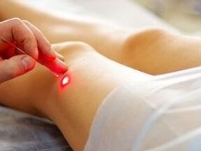 Põlveliigese artroosi ravi laseriga